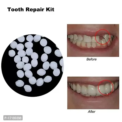 GAH Dental Thermal Beads Teeth Veneers Moldable Denture Temporary Tooth Repair 25g-thumb2