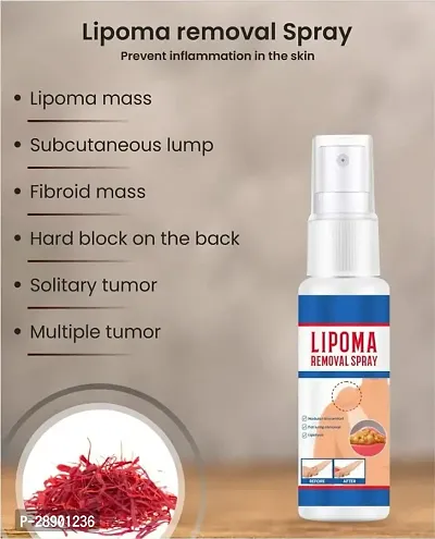 Natural Unisex Lipoma Remover Spray Relief Lipolysis Fat Lump With Lipoma Spray (30ml) Pack of 1-thumb2