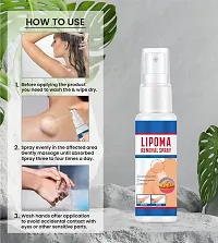 Natural Unisex Lipoma Remover Spray Relief Lipolysis Fat Lump With Lipoma Spray (30ml) Pack of 1-thumb2