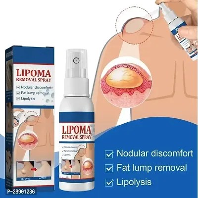 Natural Unisex Lipoma Remover Spray Relief Lipolysis Fat Lump With Lipoma Spray (30ml) Pack of 1-thumb4