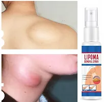 Lipoma Remover Spray Painless Herbal Spray for Lipolysis Fat Relief for Men and Women (30ml) Pack of 1-thumb3