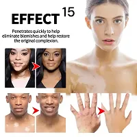 Effectively Remove Vitiligo Ointment Remove Ringworm White Spot Removal Skin Vitiligo Eliminate Vitiligo Skin Care/ 10ml (set of 3)-thumb2