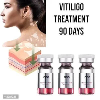 Vitiligo Ointment Herbal GEL Remove Ringworm 90 DAYS/ 10ml (set of 3)-thumb0