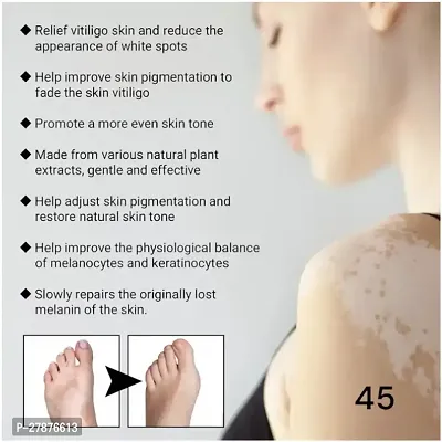 Vitiligo relief ointment /vitiligo relief spray/ Skin treatment soothing / vitiligo treatment 90 days 10ml (set of 3)-thumb3