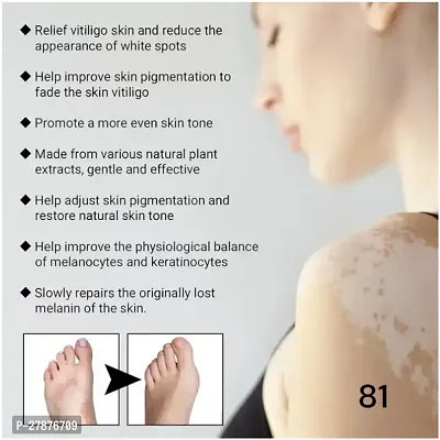 Effectively Remove/  Vitiligo White Spots/  Fades Skin Marks/  Skin Vitiligo Treatment 90 days 10ml (set of 3)-thumb3