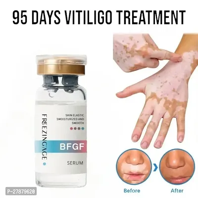 Vitiligo Repair Cream/ Pigmentation Corrector Cure Mycosis Ringworm/ White Spots Antibacterial Treatment 95 days 5ml(set of 1)