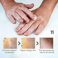 Vitiligo Repair Cream/ Pigmentation Corrector Cure Mycosis Ringworm/ White Spots Antibacterial Treatment 95 days 5ml(set of 1)-thumb1