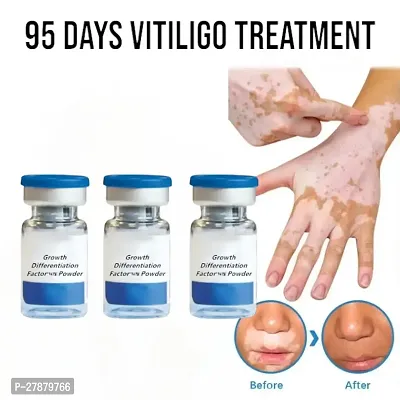 Anti vitiligo cream/ vitiligo medicine/ vitiligo removal cream/ vitiligo treatment/ White Spots Skin Removal/ 10ml (set of 3)