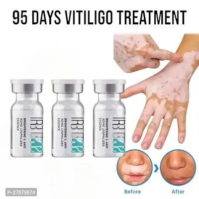 White Tag Cream Treatments/ Gently Repair Moisturizing Cream Reduces/ Vitiligo Cream Leukoplakia Treatment 95 days 10ml (set of 3)