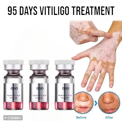 Remove Ringworm/  White Spot Removal /Upgraded White Spot/  Vitiligo Cream/ 95 days vitiligo treatment/ 10ml (set of 3)