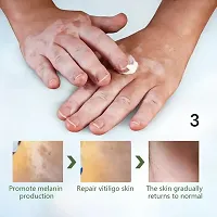 Effectively Remove Cream/ Vitiligo Ointment Remove Ringworm/  White Spot/  Vitiligo Cream /Leukoplakia Treatment/ 95 days 5ml (set of 1)-thumb1