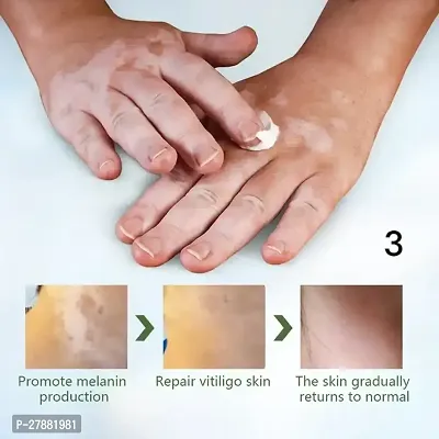 Effectively Remove Cream/ Vitiligo Ointment Remove Ringworm/  White Spot/  Vitiligo Cream /Leukoplakia Treatment/ 95 days 5ml (set of 1)-thumb2