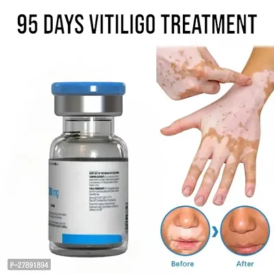 Effectively Remove/  Vitiligo Ointment Remove/ White Tag Cream Treatments/  Gently Repair Moisturizing Cream/ 95 days vitiligo treatment/ 5ml (set of 1)