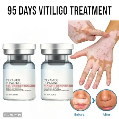 Vitiligo medicine/  vitiligo removal cream/  vitiligo treatment/ Skin treatment/  soothing White Spot Removal/  Vitiligo Care/ 95 days vitiligo treatment/ 10ml (set of 2)