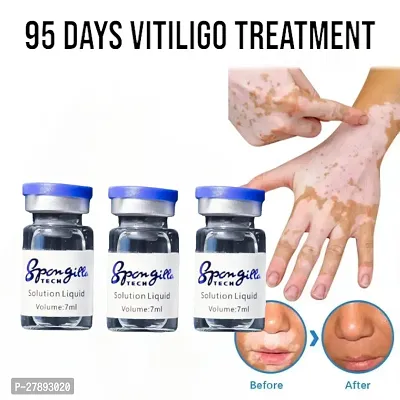 Herbal Extract /Vitiligo Ointment Remove Ringworm /White Spot Removal/ Skin Leukoplakia Disease/ Vitiligo Treatment Cream/ 10ml (set of 3)