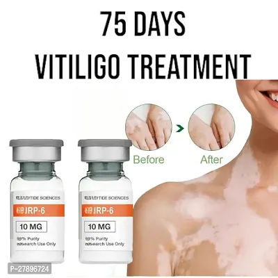 Herbal Extract Vitiligo Ointment Remove Ringworm /White Spot Removal/ Skin Vitiligo Eliminate /Vitiligo Treatment 75 days/ 10ml (set of 2)