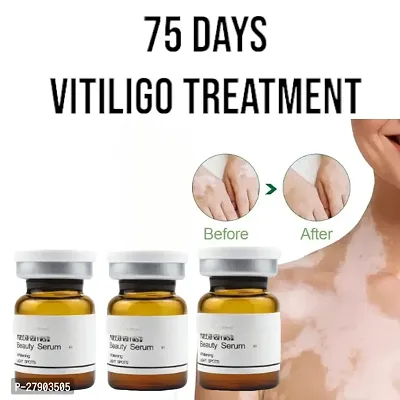 Skin Vitiligo Eliminate Cream/ Vitiligo Cream/  Vitiligo White Spots Fades Skin Marks REMOVE CREAM/ 75 days vitiligo treatment/ 10ml (set of 3)-thumb0