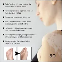 Skin Vitiligo Eliminate Cream/ Vitiligo Cream/  Vitiligo White Spots Fades Skin Marks REMOVE CREAM/ 75 days vitiligo treatment/ 10ml (set of 3)-thumb2