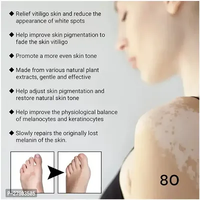 Skin Vitiligo Eliminate Cream/ Vitiligo Cream/  Vitiligo White Spots Fades Skin Marks REMOVE CREAM/ 75 days vitiligo treatment/ 10ml (set of 3)-thumb3