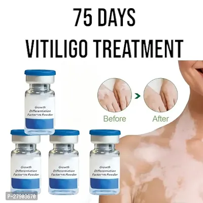 White Spot Removal Skin Vitiligo Eliminate Vitiligo Cream/ 75 days treatment/ 10ml (set of 4)