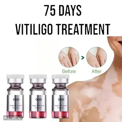 Vitiligo treatment cream Vitiligo derma relief Skin treatment soothing White Spot Removal/ 75 days treatment/ (set of 3)