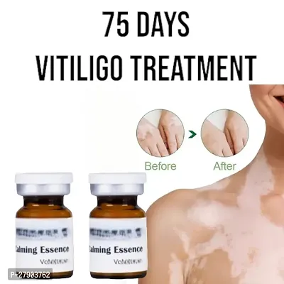 Herbal Extract Vitiligo Ointment Remove Ringworm White Spot Removal Skin Leukoplakia Disease Cream/ 75days treatment/ 10ml(set of 2)