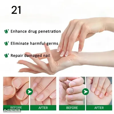 Nail treatment fungus / Nail vitamins medicine for nail fungus / Nail vitamins for stronger nails/ 5ML (set of 1)-thumb3