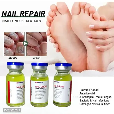 Nail Fungus Laser Treatment  Fingernails Toenails Onychomycosis Therapy Cure Unisex Foot Care / 10ml (set of 3)