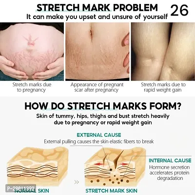 Stretch Mark Cream, Removes Pregnancy stretch marks, Scar removal and Moisturizing Cream, Stretch mark remover cream/ 5ml (set of 1)-thumb3