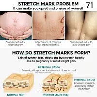 Stretch Marks Removal Cream for Pregnancy 5ml-thumb2