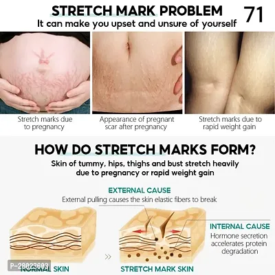 Stretch Marks Removal Cream for Pregnancy 5ml-thumb3