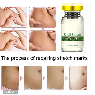 stretch marks cream,  stretch mark removal cream,   stretch mark cream during pregnancy,  stretch mark removal medicine/ 5ml (set of 1)