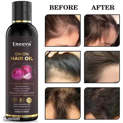 Eneeva Onion oil For Hair Fall Control, Hair Growth  Hair Regrowth- Best Formula For Hair Fall Treatment, Increase the hair Growth, Boost the hair Regrowth, Control Dandruff, Stronger, Thicker and st